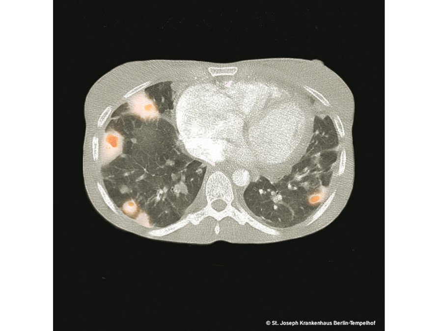 Multifokale Pulmonale Infiltrate