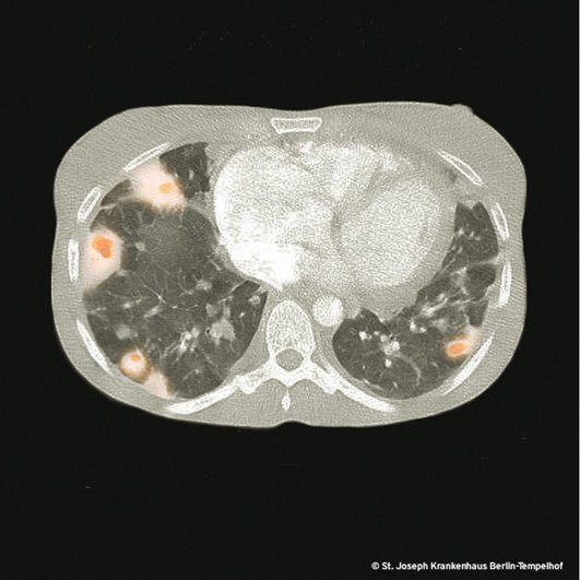 Multifokale Pulmonale Infiltrate